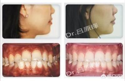 北京正畸牙齿哪里靠谱,主要还是看狗狗口臭