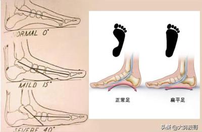 平脚底为什么不能当武警兵,征兵体检标准
